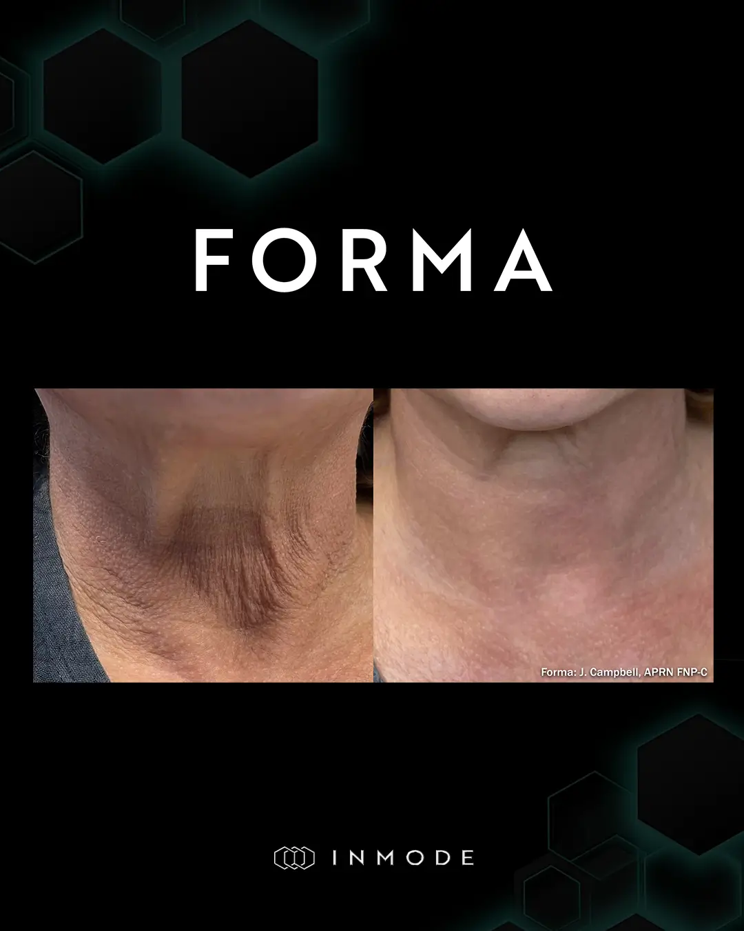 Forma facial rejuvenation treatment